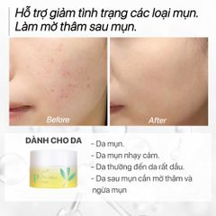 Kem Dưỡng Da Mụn Trà Nghệ GUO - Pro Acne Cream 30g, Kích Thích Làm Dịu Da, Ngăn Ngừa Mụn Tái Phát