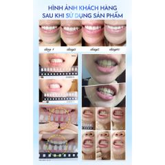 Miếng Dán Làm Trắng Răng Anriea Than Tre - Không Gây Ê Buốt, Dễ Dàng Sử Dụng Tại Nhà, Giúp Sáng Răng Tự Nhiên