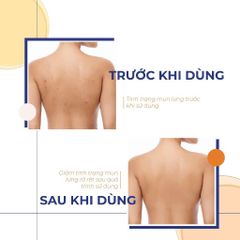 Xịt Mụn Lưng FIXDERMA Salyzap For Body Acne Body Spray 50ml