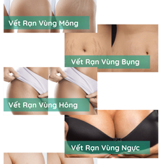 Kem tr.ị rạn da và chống sẹo cho mẹ bầu và sau sinh StretcHeal hàng Mỹ 180ml