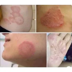 Kem bôi bọ cạp vàng các loại nấm ngứa hắc lào