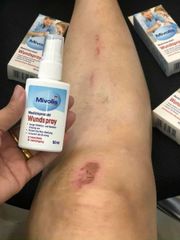 Xịt Khử Trùng và Làm Lành Vết Thương Mivolis WundSpray 50ml - Chăm Sóc Vết Thương An Toàn Cho Gia Đình, Không Chứa Cồn, Dễ Sử Dụng