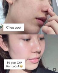 CNP Peel Da Combo 5 Tép - Tẩy tế bào chết sinh học độc đáo cho làn da tươi trẻ và rạng rỡ, sản phẩm chăm sóc da hiệu quả
