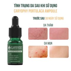 Serum Caryophy Portulaca 30ml - Giảm Mụn, Mờ Thâm, Se Khít Lỗ Chân Lông - Dưỡng Da Từ Thiên Nhiên, An Toàn Cho Tất Cả Các Loại Da