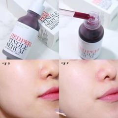 Tinh Chất Red Peel Da Sinh Học Tingle So Natural 10ml