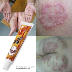Kem Bôi Da Liễu CHA-REN - Giảm Ngứa, Hắc Lào, Vảy Nến, Lang Ben - Hàng Xuất Khẩu Châu Âu Chất Lượng Cao