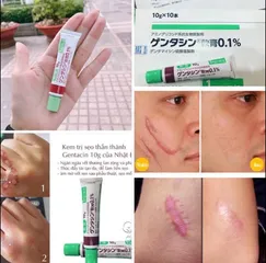 Kem Giảm Mờ Sẹo Gentacin Sulfate - 10G
