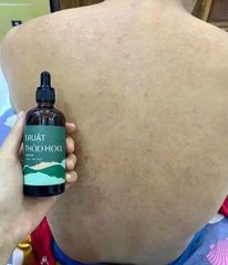 Truật Thảo Hoa D'Vi Nature - Sản Phẩm Chăm Sóc Da Hỗ Trợ Giảm Mụn Lưng & Mụn Ngực Từ Thiên Nhiên, An Toàn Và Hiệu Quả