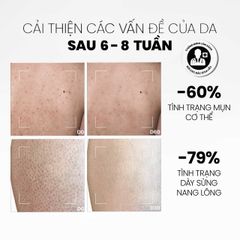 Sữa Tắm Giảm Mụn & Tẩy Tế Bào Chết MD Care - Chăm Sóc Da Mịn Màng Với AHAs & BHA, Phù Hợp Cho Da Dầu & Da Mụn