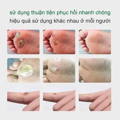 Kem Tẩy Mụn Cóc 10g - Gel Tẩy Nốt Ruồi Hiệu Quả 7 Ngày, Làm Sạch Da Mịn Màng, Giảm Sẹo Sẫm Màu, Dưỡng Ẩm Chất Lượng