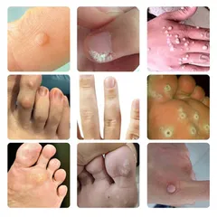 Kem Tẩy Mụn Cóc 10g - Gel Tẩy Nốt Ruồi Hiệu Quả 7 Ngày, Làm Sạch Da Mịn Màng, Giảm Sẹo Sẫm Màu, Dưỡng Ẩm Chất Lượng