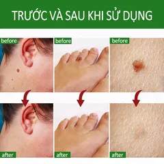 Kem Tẩy Mụn Cóc 10g - Gel Tẩy Nốt Ruồi Hiệu Quả 7 Ngày, Làm Sạch Da Mịn Màng, Giảm Sẹo Sẫm Màu, Dưỡng Ẩm Chất Lượng