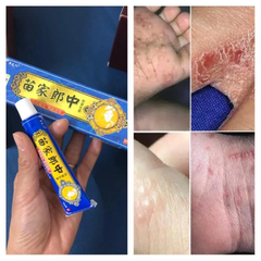 Kem Bôi Đông Y Chữa Nấm Ngứa 15g - Hiệu Quả Nhanh Chóng, Điều Trị Viêm Da, Dị Ứng và Nấm Tay Chân