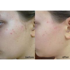 Kem Dưỡng SVR Sebiaclear Mat + Pores 40ml - Kiềm Dầu, Se Khít Lỗ Chân Lông, Chuyên Dùng Cho Da Hỗn Hợp, Da Dầu Nhạy Cảm