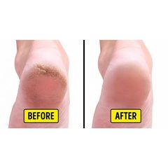 Kem Dưỡng Nứt Gót Chân và Tay Shiseido Urea 10% 100g 265876