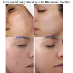 Viên uống bổ sung Kẽm Blackmores 84 viên - Hỗ trợ làm đẹp da, ngừa mụn và dưỡng da khỏe mạnh từ Úc
