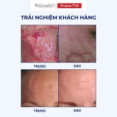 Miếng Dán Xóa Sẹo Lồi REJUVASKIN Scar FX 3.75x7.5cm - Chăm Sóc Da Chất Lượng Cao, Ngăn Ngừa Sẹo Sau Phẫu Thuật, Đảm Bảo An Toàn