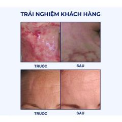 Miếng Dán Hỗ Trợ Xóa Mờ Sẹo Lồi REJUVASKIN Scar FX 2,5x55cm - Giúp Làm Phẳng Sẹo Sau Phẫu Thuật, Bỏng, Tăng Cường Độ Mềm Mịn Da