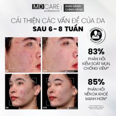 Sữa Rửa Mặt Bọt MD CARE BHA Cho Da Dầu Mụn Nhạy Cảm 200ml - Giải Pháp Làm Sạch Sâu, Kiểm Soát Dầu và Ngăn Ngừa Mụn