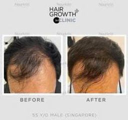 Viên Uống Mọc Tóc Nourkrin Hair Growth+ In Clinic 90 Viên - Giải Pháp Hiệu Quả Chống Rụng Tóc, Tăng Mật Độ và Chất Lượng Tóc