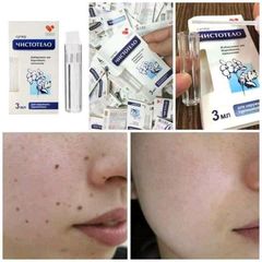 Gel tẩy nốt ruồi và mụn cóc Dvelinil Nga 3ml - Giải pháp làm sạch da hiệu quả cho nốt ruồi và mụn cơm