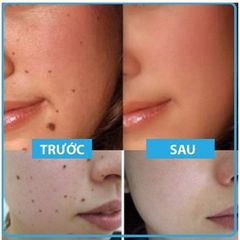 Gel tẩy nốt ruồi và mụn cóc Dvelinil Nga 3ml - Giải pháp làm sạch da hiệu quả cho nốt ruồi và mụn cơm