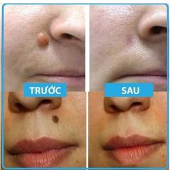 Gel tẩy nốt ruồi và mụn cóc Dvelinil Nga 3ml - Giải pháp làm sạch da hiệu quả cho nốt ruồi và mụn cơm