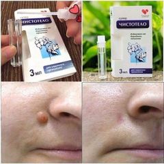 Gel tẩy nốt ruồi và mụn cóc Dvelinil Nga 3ml - Giải pháp làm sạch da hiệu quả cho nốt ruồi và mụn cơm