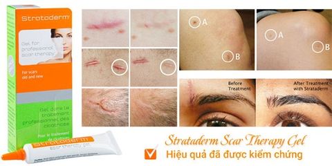 Strataderm Gel Hỗ Trợ Giảm Sẹo - Hiệu Quả Trong Việc Làm Mờ Sẹo Lâu Năm, Không Gây Ngứa, Dễ Dàng Sử Dụng