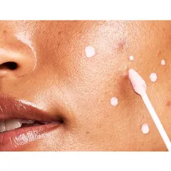 Hyaestic Chấm Mụn Spot Treatment 2.5% Benzoyl Peroxide - Giảm Mụn Sưng, Đỏ Da, Trị Mụn Hiệu Quả Cho Da Dầu Mụn