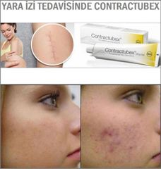 Kem Làm Mờ Sẹo Contractubex 30g - Giải Pháp Hiệu Quả Xóa Mờ Sẹo Lồi, Sẹo Phì Đại, Tái Tạo Da Mịn Màng Từ Đức