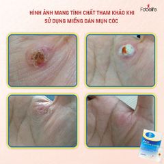 Miếng Dán MỤN CÓC Mụn Cơm Corn plaster KangDi Fobe N1 - hộp 6 miếng