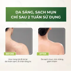 Sữa Tắm Mụn Lưng Acniver Giúp Giảm Viêm Nang Lông, Làm Sạch Lỗ Chân Lông Thông Thoáng N1 - Chai 210ml