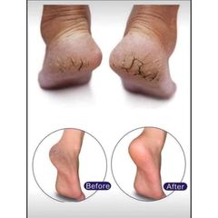 [Hàng Đức] Kem bôi nứt gót chân Schrunden Salbe, giảm nứt nẻ, cung cấp dưỡng ẩm cho da chân 316888