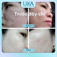 Bộ sản phẩm giảm thâm nám AiThan - Kem dưỡng trắng da, làm sáng và làm mờ vết nám hiệu quả, giá trị cho làn da khỏe đẹp.