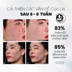 MD CARE Sữa Rửa Mặt BHA Dạng Bọt - Giảm Nhờn, Ngăn Ngừa Mụn, Làm Sạch Lỗ Chân Lông, Dưỡng Ẩm Cho Da Dầu & Nhạy Cảm (200ml)