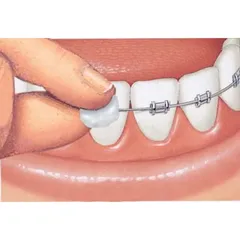 Sáp nha khoa Gum Ortho Wax + Vitamin E cho răng niềng 1 vỉ (USA)