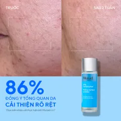 Murad Daily Clarifying Peel 95ml - Tẩy Da Chết Hóa Học, Làm Sạch Sâu, Giảm Mụn, Sáng Da Cho Làn Da Khỏe Mạnh