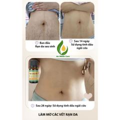 Tinh Dầu Ngải Cứu & Gừng - Chăm Sóc Da, Giảm Đau Đầu, Giúp Ngủ Sâu, Dưỡng Ẩm Tự Nhiên, Hỗ Trợ Làm Mờ Vết Rạn Da