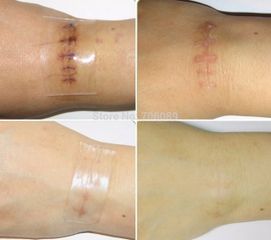 Tấm Dán Xoá Mờ Sẹo Lồi Scar FX - Sản Phẩm Hỗ Trợ Khắc Phục Sẹo Chất Lượng Mỹ, Dễ Dàng Sử Dụng, Hiệu Quả Rõ Rệt