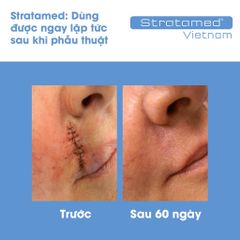 Combo Gel Silicone Strataderm & Stratamed cho vết thương hở, hỗ trợ ngăn ngừa sẹo xấu, làm mềm và phẳng vết sẹo, hiệu quả cao.