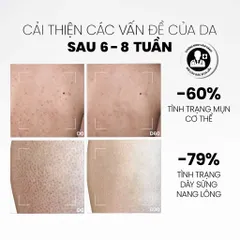 Sữa Dưỡng Thể Cho Da Mụn MD Care 200ml - Giảm Mụn, Cung Cấp Độ Ẩm, Dưỡng Sáng Da, Thành Phần Tự Nhiên, Sản Phẩm Chăm Sóc Da Thân Thiện