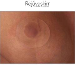 Miếng Dán Xóa Mờ Sẹo Lồi REJUVASKIN Scar FX Breast Piece - Giải Pháp Hiệu Quả Cho Da, Hỗ Trợ Làm Mờ Sẹo Tham, Đổi Mới Làn Da