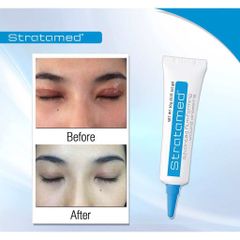 Gel Stratamed làm mờ sẹo - Phục hồi và ngăn ngừa sẹo lồi, sẹo phì đại từ Stratpharma Thụy Sĩ 30g