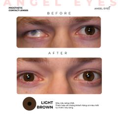 Kính áp tròng thẩm mỹ Angel Eyes - Lens che khuyết điểm cho mắt bị đục thủy tinh thể, cườm, thiết kế thời trang Hàn Quốc