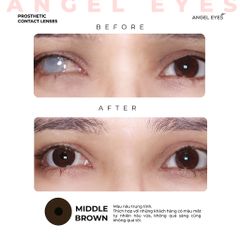Kính áp tròng thẩm mỹ Angel Eyes - Lens che khuyết điểm cho mắt bị đục thủy tinh thể, cườm, thiết kế thời trang Hàn Quốc