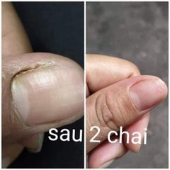 Serum Dưỡng Cứng Móng Phục Hồi Nấm Móng & Hư Khóe - Giải Pháp Cho Móng Yếu, Hư Tổn, 4ml