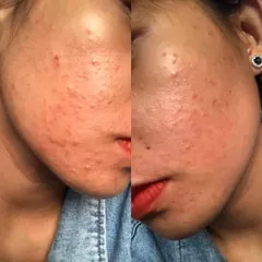 Serum Giảm Mụn Thâm 5 Trong 1 - Hiệu Quả Sau 7 Ngày, Cấp Ẩm, Phục Hồi Da Từ Thành Phần Thiên Nhiên, An Toàn Cho Da Nhạy Cảm