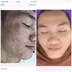Serum Giảm Mụn Thâm 5 Trong 1 - Hiệu Quả Sau 7 Ngày, Cấp Ẩm, Phục Hồi Da Từ Thành Phần Thiên Nhiên, An Toàn Cho Da Nhạy Cảm