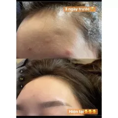 Serum Giảm Mụn Thâm 5 Trong 1 - Hiệu Quả Sau 7 Ngày, Cấp Ẩm, Phục Hồi Da Từ Thành Phần Thiên Nhiên, An Toàn Cho Da Nhạy Cảm